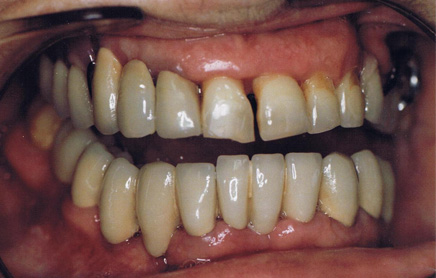 Piorrea: Rigenerazione ossea