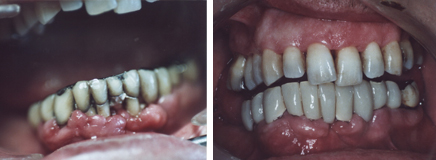 trattameto della piorrea su paziente con scarsa igene orale