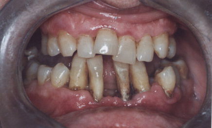 trattamento della piorrea: grave periodontite espulsiva